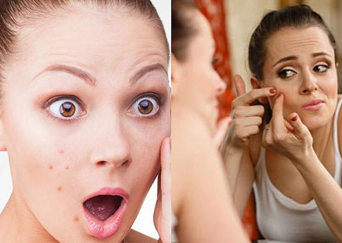 Top 10 Medicines to Treat Pimples